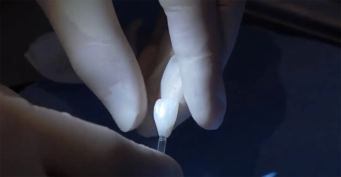 No-Prep Veneers At Atlanta Dental Spa